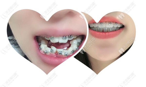 齙牙正畸案例