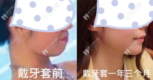 地包天矯正案例