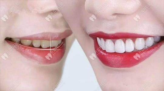 皓齒美白前后對(duì)比