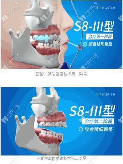 正雅S8、S9、S10頜位重建術(shù)