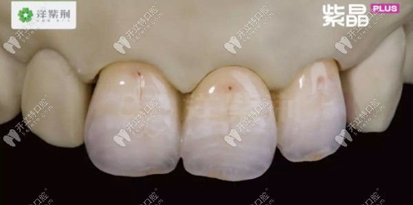 洋紫荊全瓷牙美學(xué)修復(fù)