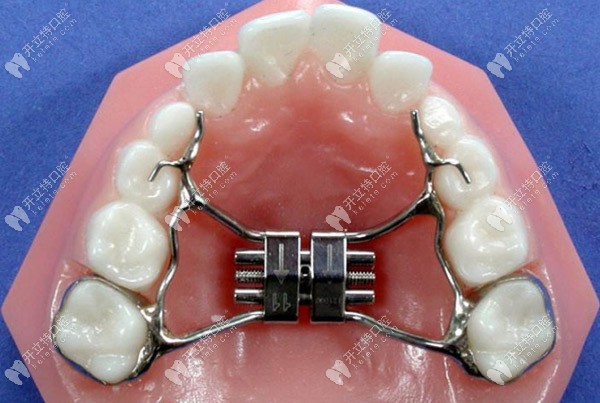 常規(guī)的腭中縫擴(kuò)弓器