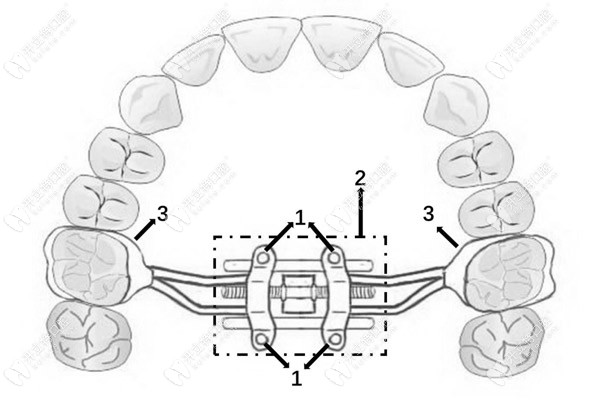 mse上頜骨性擴(kuò)弓器