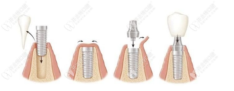 種植牙過(guò)程