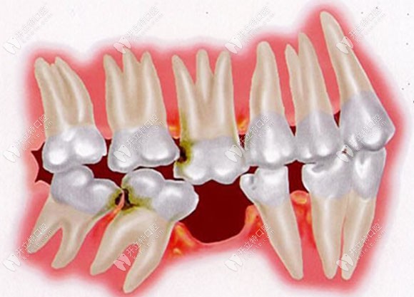 缺一顆牙后的連鎖反應(yīng) 缺一顆牙后的連鎖反應(yīng)