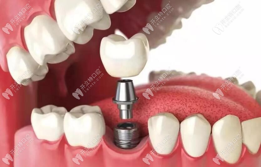 種植假牙修復技術