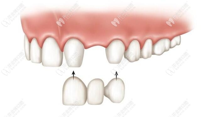 固定假牙修復技術
