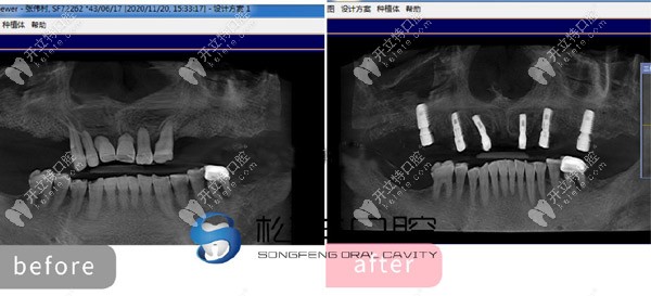 上半口做了6顆即刻負重種植牙的CT片