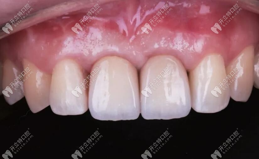 整個修復病例完成后的情況