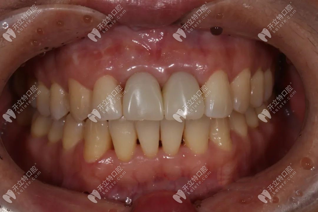 顧客臨時牙佩戴后情況