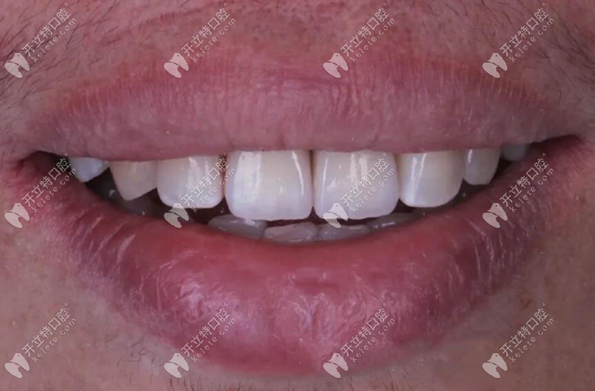 種植牙完成修復后的情況