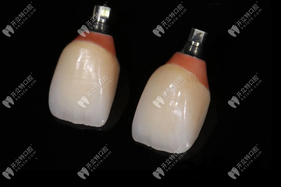 種植后長久性牙冠的修復